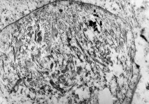 F,49y. | rhabdomyosarcoma - pankreas F,49y. | rhabdomyosarcoma - pankreas